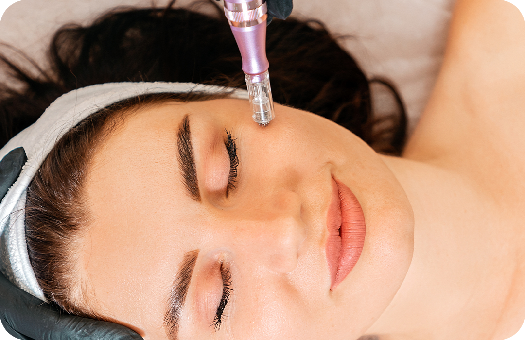 Microneedling